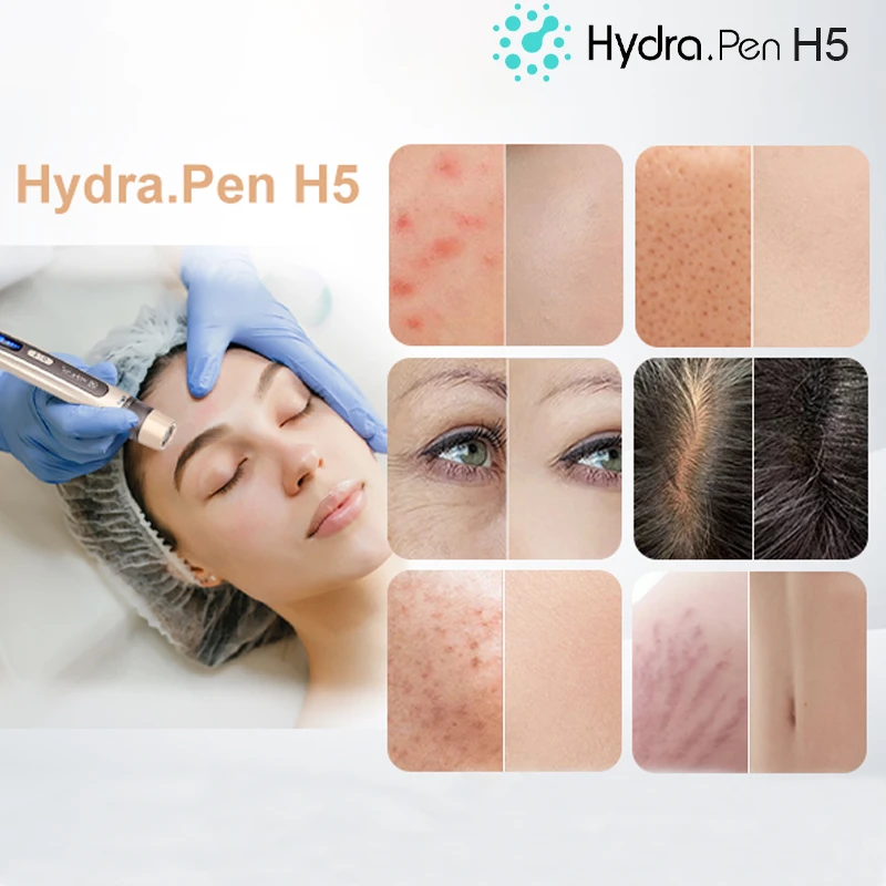 hydra. pen h5 microneedling effect