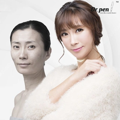 dr pen microneedling review japan effect