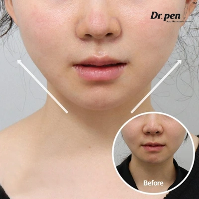 Dr Pen Mezoterapia Mikroigłowa Efekty: anti-ageing