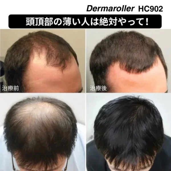 ダーマローラー HC902 ヘッドケア - 育毛促進