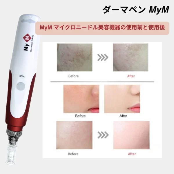 ダーマペン MyM マイクロニードル美顔器 効果前後